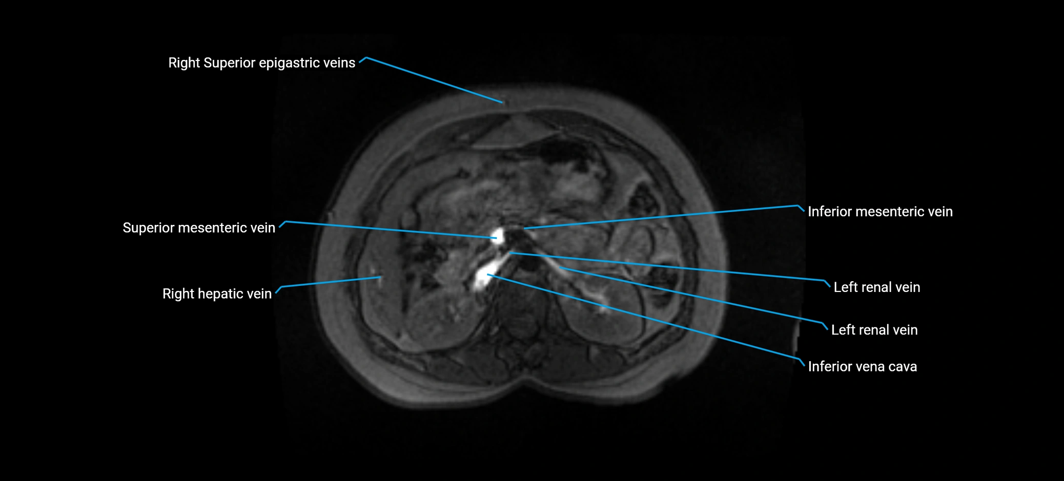 MRV abdomen pelvis & lower limb axial cross sectional anatomy labelled MRI image 60 (1).webp